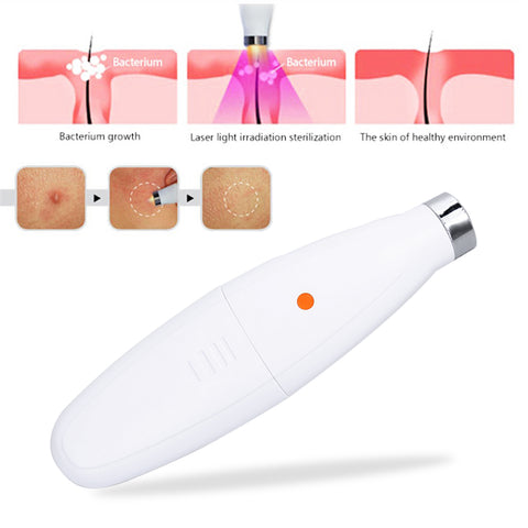 Laser Acne Removal - French Luxe 